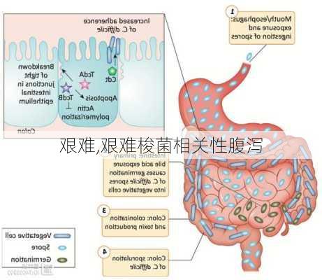 艰难,艰难梭菌相关性腹泻-第2张图片-星梦范文网